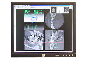 歯科用CTをを活用した診査・診断
